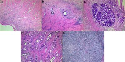 High expressions of CD10, FAP and GPR77 in CAFs are associated with chemoresistance and worse prognosis in gastric cancer